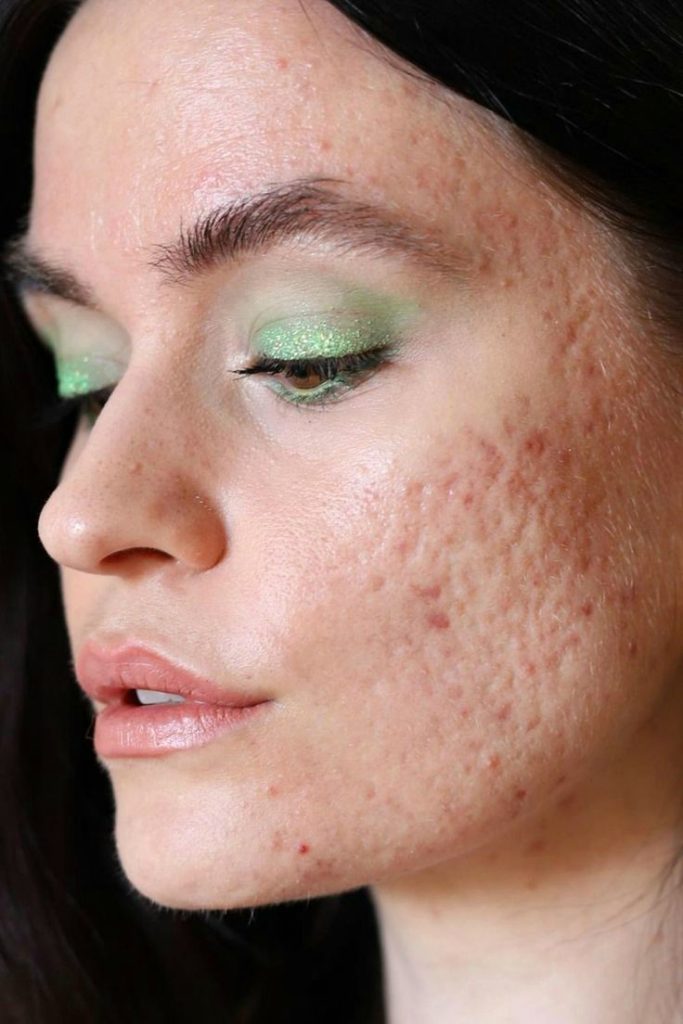 بهترین راه برای از بین بردن جای جوش