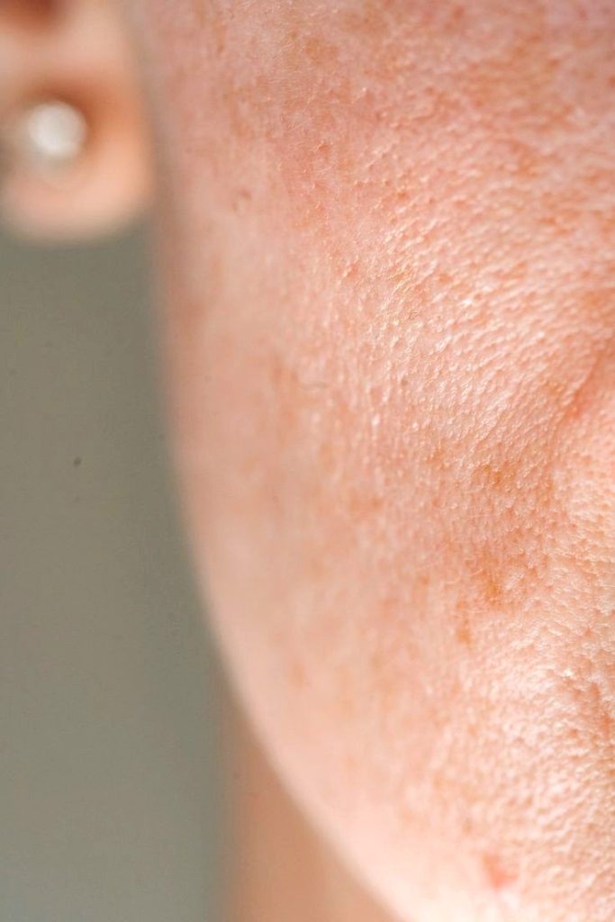 درمان پوست مرغی