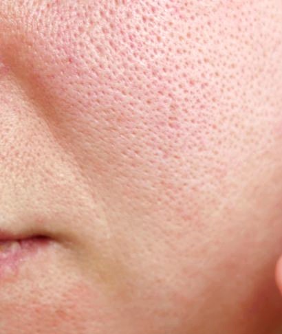 درمان منافذ باز