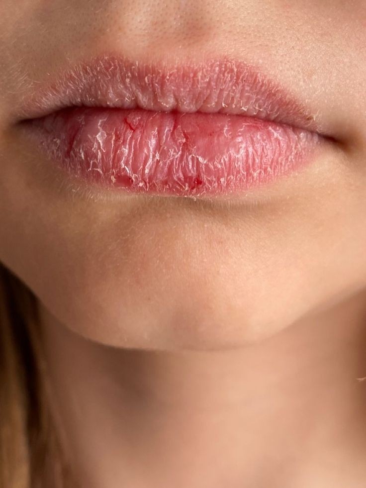 درمان خشکی لب