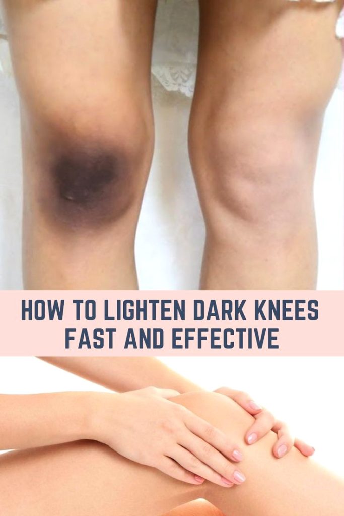 رفع تیرگی پوست بدن( آرنج ، زانو، بیکینی،زیربغل )